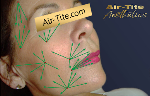 facial diagram showing popular microcannula coverage points