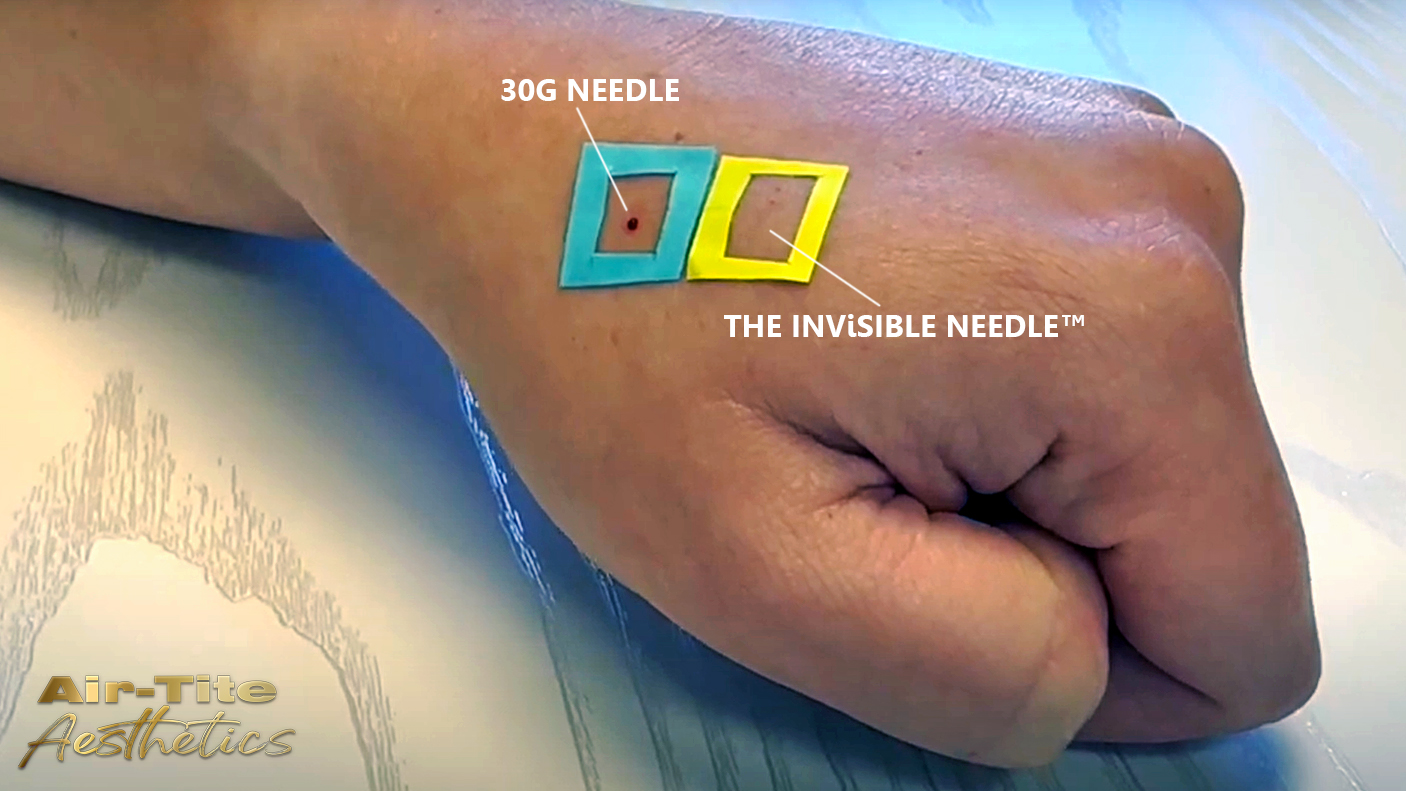 Invisible Needle vs 30G Needle Bleeding