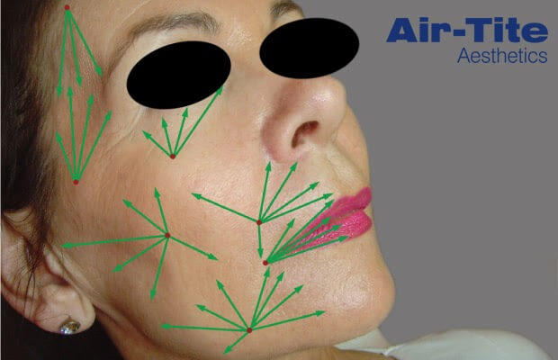facial diagram showing popular microcannula coverage points